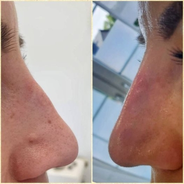 Wyrównanie asymetrii grzbietu nosa kwasem hialuronowym