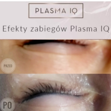 Plasma IQ